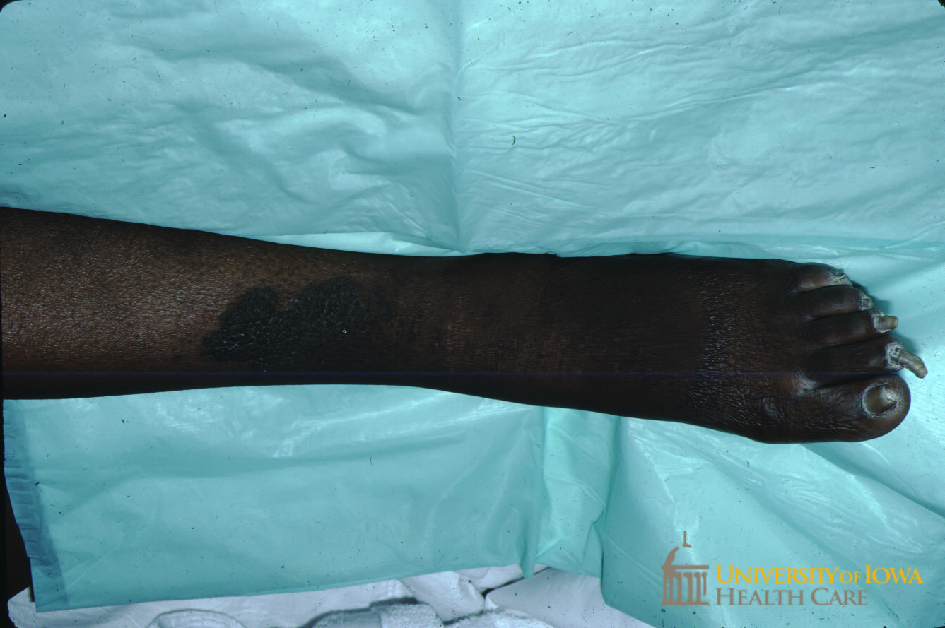 Hyperpigmented velvety plaques on the lower extremity. (click images for higher resolution).